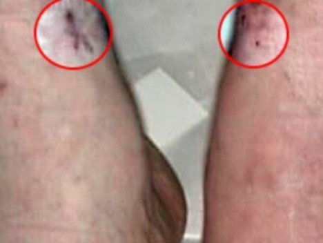 Раны Майкла Джексона