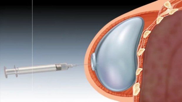 Восстановление груди