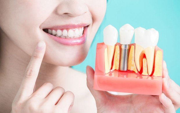 Имплантация зубов преимущества и особенности