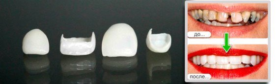 Виниры на зубы