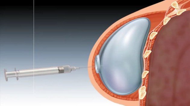 Восстановление груди