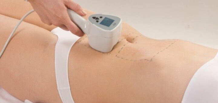 Где сделать лазерное удаление растяжек