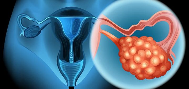 Возможности лечения рака яичников в Германии