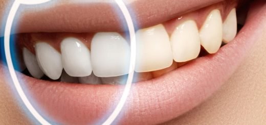 отбеливание зубов