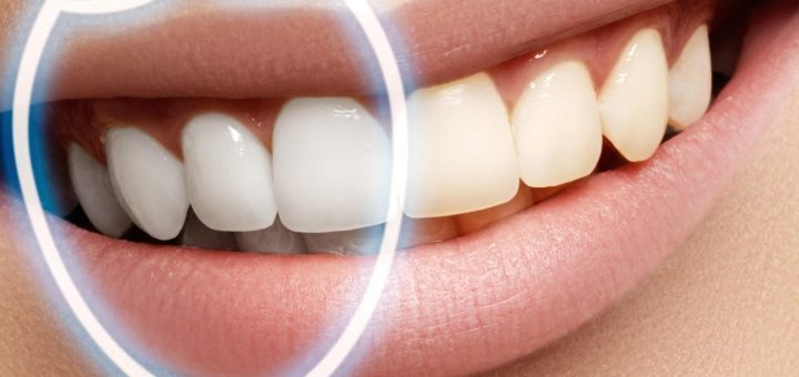 отбеливание зубов