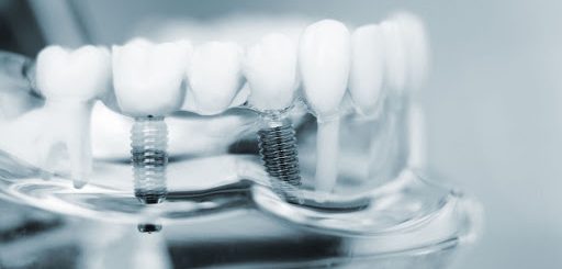 3d имплантация